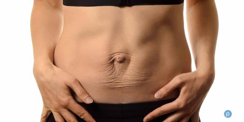 Diastasis Recti understanding abdominal separation